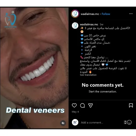 كرييتف فينير الأسنان وادي الماس